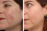 How Much Is Facial Laser Treatment