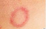 Photos of Ringworm Symptoms In Humans Mayo Clinic
