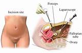 Tubal Ligation Covered By Insurance Pictures