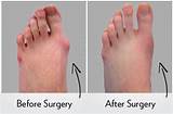 Foot Surgery For Bunions Recovery Images
