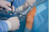Pictures of Osgood Schlatter Surgery Recovery Time