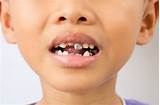 Silver Caps On Kids Teeth Photos