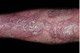 Pictures of Plaque Psoriasis Treatment Drugs