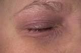 Eczema Eyelids Home Remedies Images