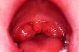 Septic Tonsillitis Home Remedies Photos