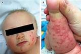 Photos of Herpes On Foot Treatment