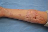 Makeup For Surgical Scars Images