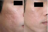 Filler Treatment For Acne Scars Pictures