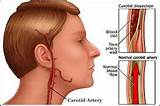 Carotid Artery Stroke Recovery Pictures