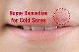 Fast Home Remedies For Cold Sores