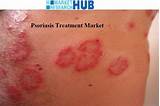 What Is The Latest Treatment For Psoriasis Pictures