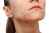 Photos of Allergic Reaction Acne Treatment