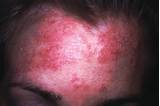Eczema On Forehead Treatment Images