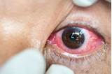 Images of Herpes Around The Eye Treatment