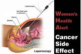 Side Effects After A Hysterectomy Surgery Images