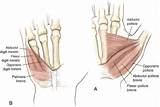 Images of Intrinsic Hand Muscle Strengthening Exercises