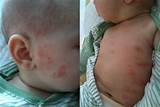 Baby Food Allergy Treatment Images