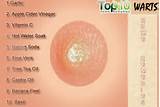 Hpv Wart Removal Home Remedies Images