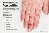 Images of Vasculitis Home Remedies