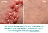 Images of Where Can Herpes Break Out
