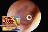 Images of Medication For Inner Ear Infection In Adults