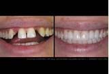 Images of Much Does Denture Repair Cost