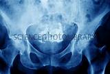 Images of Pelvic Calcification Treatment