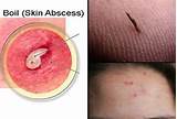 Pictures of Skin Boil Home Remedies