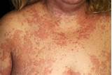 Severe Allergic Skin Reaction Treatment