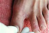 Medication For Blisters On Feet Pictures