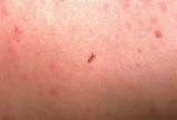 Photos of How To Get Rid Of Bed Bugs Rash