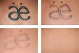 Laser Tattoo Removal Pictures After Each Treatment Images