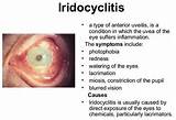 Iridocyclitis Treatment Images