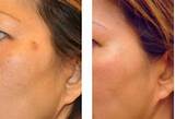 Laser Treatment To Remove Brown Spots