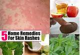 Images of Skin Rash Treatment Home Remedies