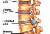 Pictures of Cervical Spine Disc Bulge Treatment