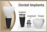 Pictures of Does Dental Insurance Cover Crowns