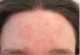 Eczema On Forehead Treatment