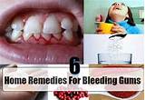 Gum Bleeding Home Remedies Images