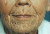 Facial Skin Treatments Wrinkles Images