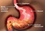 Excessive Gas And Colon Cancer