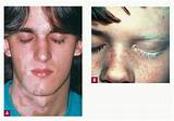 Photos of Segmental Vitiligo Treatment