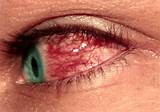 Pictures of Medical Word For Pink Eye