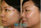 Laser Treatment For Acne Scars African American Images