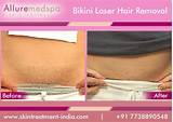 Bikini Laser Treatment Images