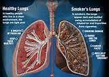 Life Insurance Smoker Vs Nonsmoker Pictures