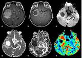 Glioblastoma Multiforme Treatment Options Photos