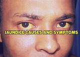 Images of Jaundice Symptoms And Treatment