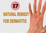 Dermatitis Herpetiformis Home Remedies Photos