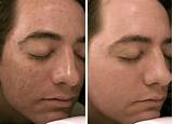 What Is Micro Needling Treatment Pictures
